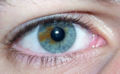 Sectoral heterochromia.jpg