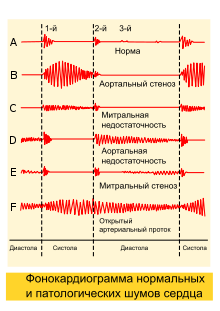 Phonocardiograms from normal and abnormal heart sounds-ru.svg